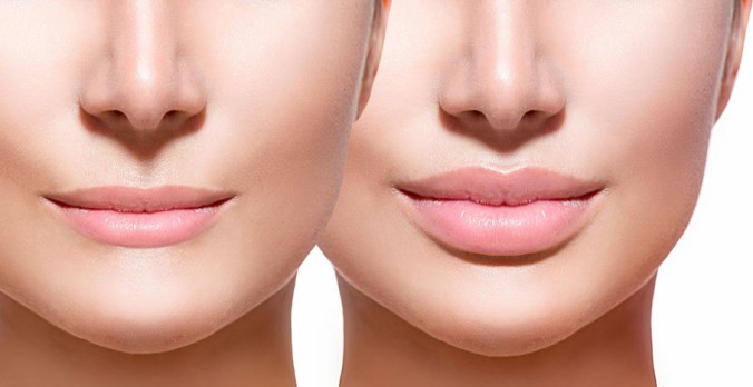 Preenchimento labial