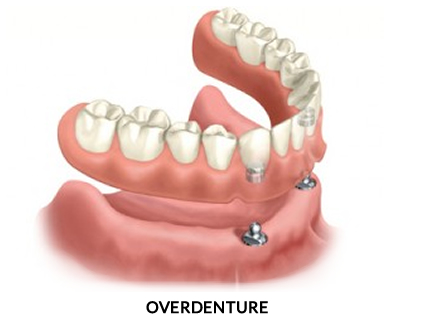 Prótese Dentária