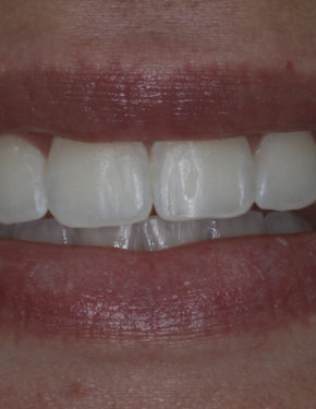 clareamento_dental_depois