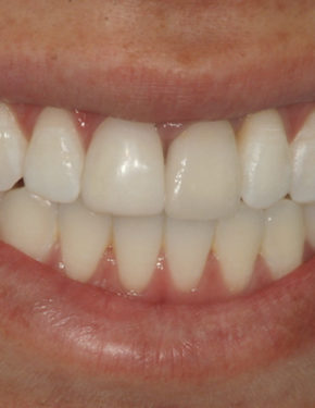 clareamento_estetica_depois