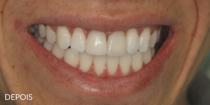 clareamento_estetica_depois