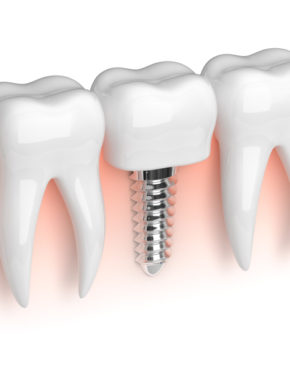 implante-dentario12