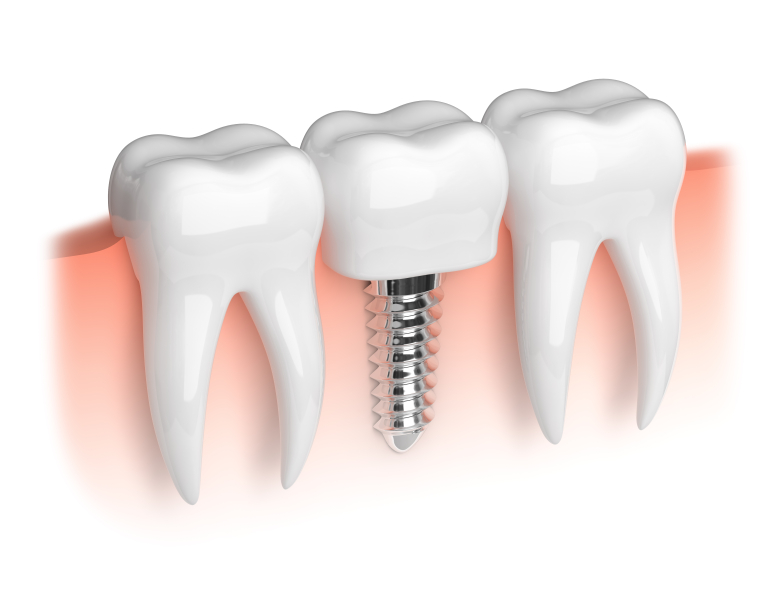 implante-dentario12